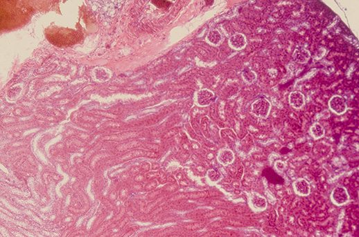 Njurskador bland barn efter vankomycin