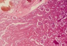 Njursjukdom lika vanligt som typ 2 diabetes