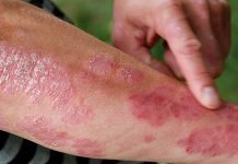 Långvarig effekt av IL17-hämmare