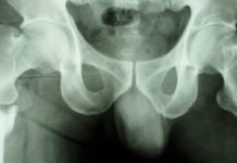 Hopp för bättre skydd mot frakturer