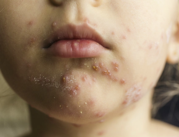 Vattkoppsvaccin kan bli gratis – oklart om bältros