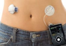 Konstgjord bukspottkörtel normaliserar glukosvärden