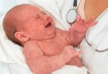 Minst fem dödsfall i mässling i EU på ett år Läkemedelsvärlden