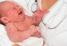 ”Vaccin viktigt skydd för de minsta” Läkemedelsvärlden, mässling