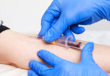 Blodprov hittar Alzheimers sjukdom i primärvården Blodet, prov, covid-19