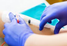 Prövar stamceller från navelsträngar mot covid-19 Läkemedelsvärlden