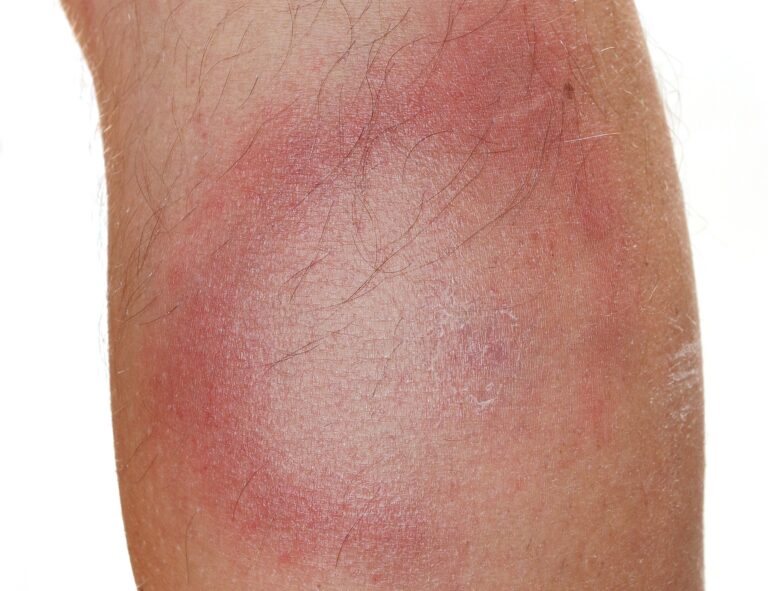 Bra effekt efter tre doser i studie av borreliavaccin