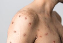 ”Intresset för vaccination är mycket stort” Läkemedelsvärlden