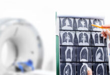 ”Screening för lungcancer kan rädda 500 liv om året” Läkemedelsvärlden