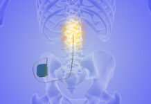 Försiktigt ja till ryggmärgsstimulering Läkemedelsvärlden