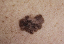 Hälften cancerfria i minst tio år efter immunterapi Läkemedelsvärlden