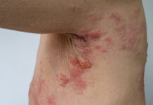 Nej till subvention av effektivt bältrosvaccin Läkemedelsvärlden