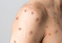 Mpox ökar igen trots vaccinering Läkemedelsvärlden