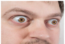 Tepezza första läkemedlet mot Graves oftalmopati Läkemedelsvärlden