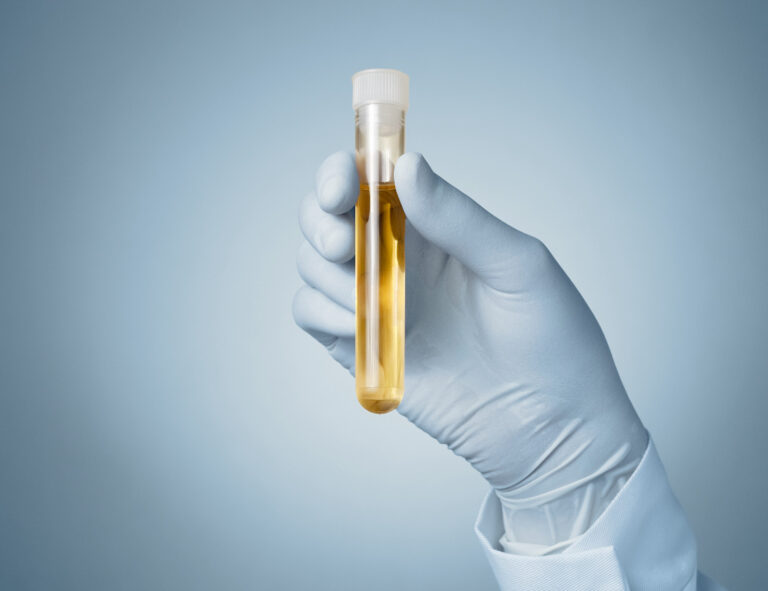 Ny studie: Prostatacancer kan hittas med urinprov